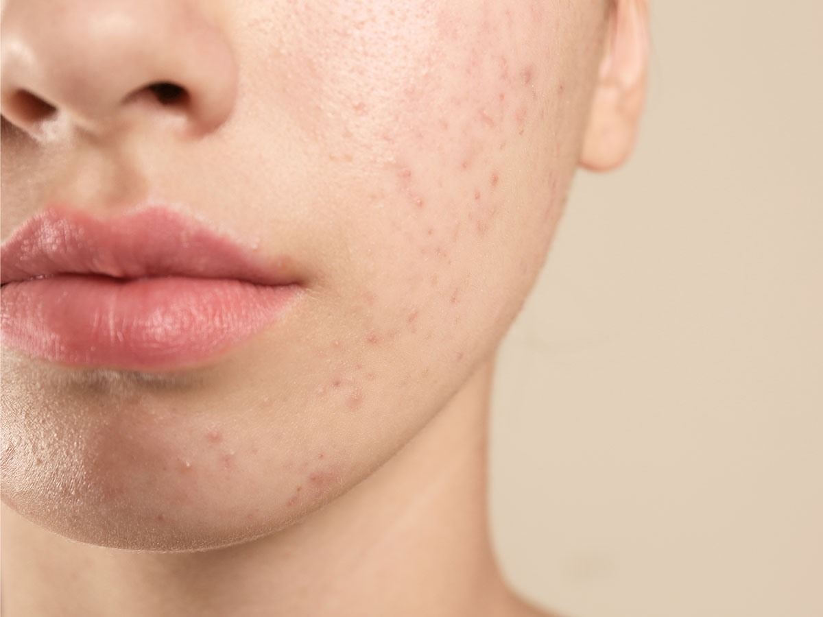 Mi experiencia con la Isotretinoína y cómo superé el acné (al fin)